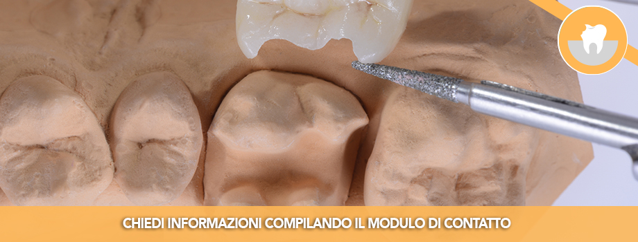 Intarsio Dentale per il ripristino estetico e funzionale